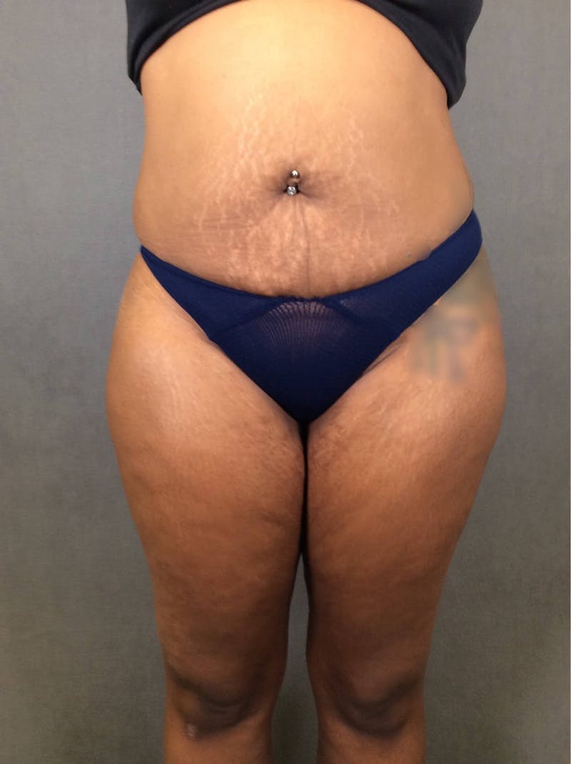 Brazilian Butt Lift Before & After Gallery - Patient 167408773 - Image 5