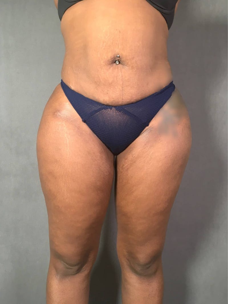 Brazilian Butt Lift Before & After Gallery - Patient 167408773 - Image 6
