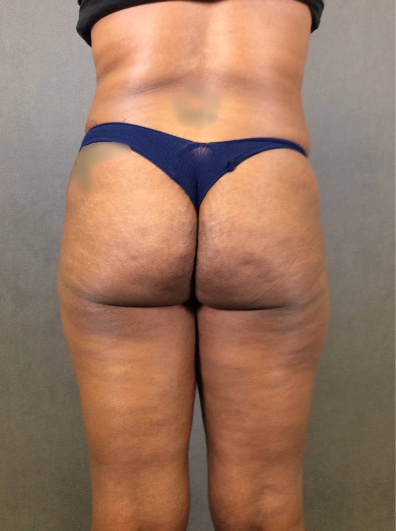 Brazilian Butt Lift Before & After Gallery - Patient 167408773 - Image 1