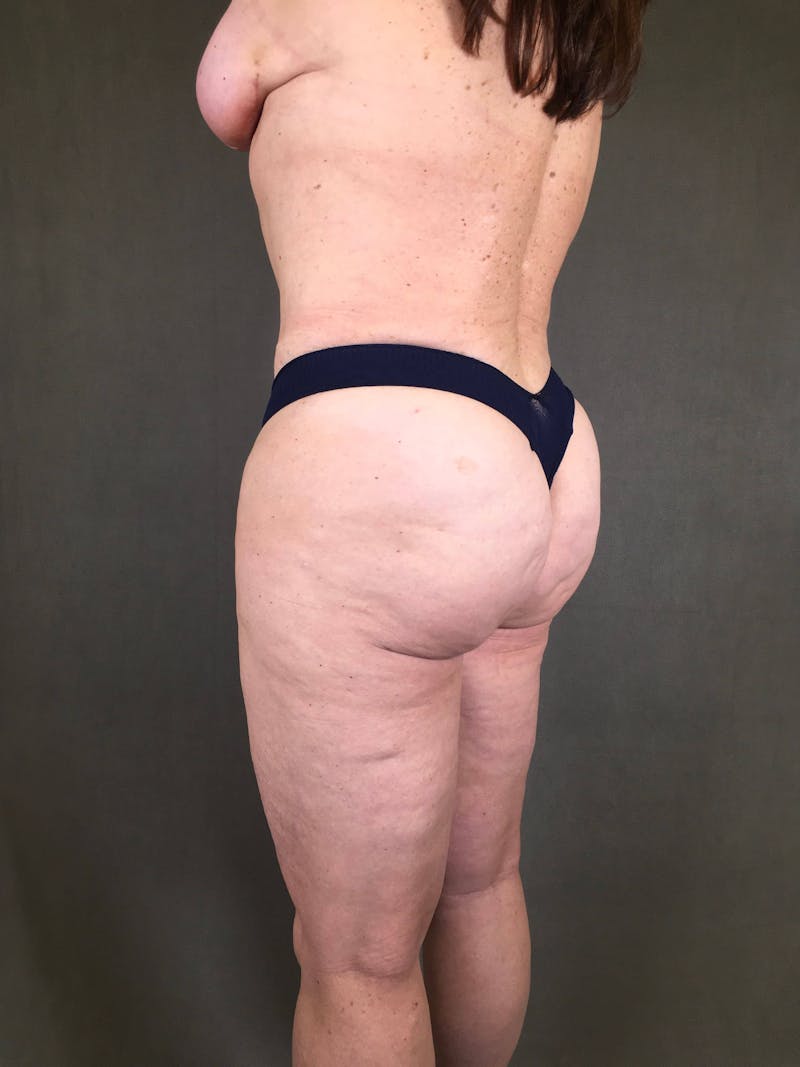 Brazilian Butt Lift Before & After Gallery - Patient 167408774 - Image 4