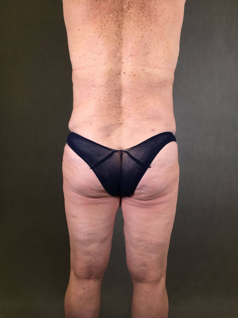 Brazilian Butt Lift Before & After Gallery - Patient 167408774 - Image 1