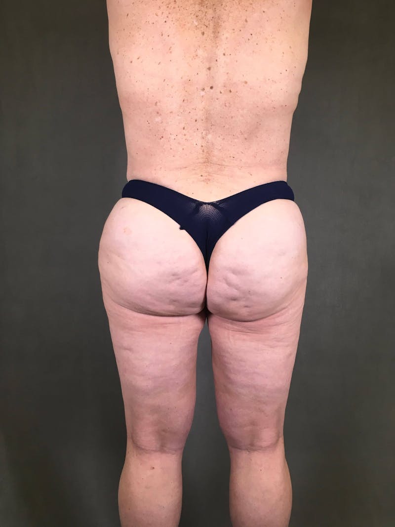 Brazilian Butt Lift Before & After Gallery - Patient 167408774 - Image 2