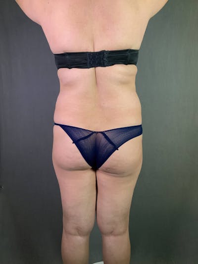 Brazilian Butt Lift Before & After Gallery - Patient 167408780 - Image 1