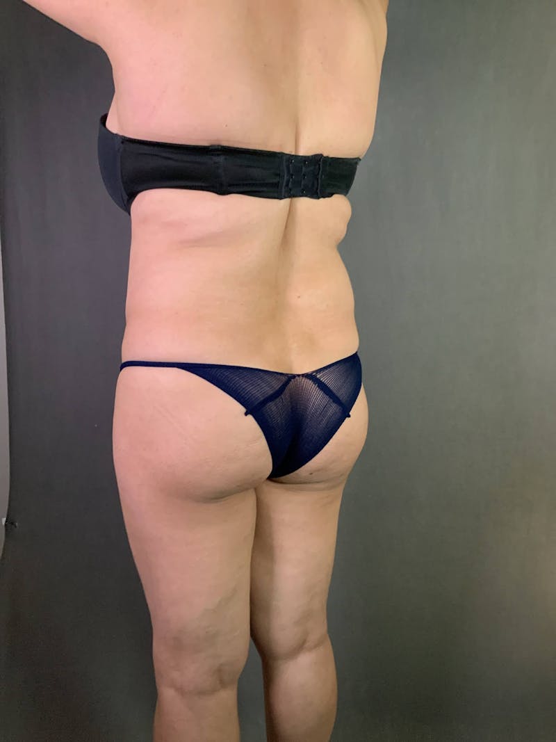 Brazilian Butt Lift Before & After Gallery - Patient 167408780 - Image 5