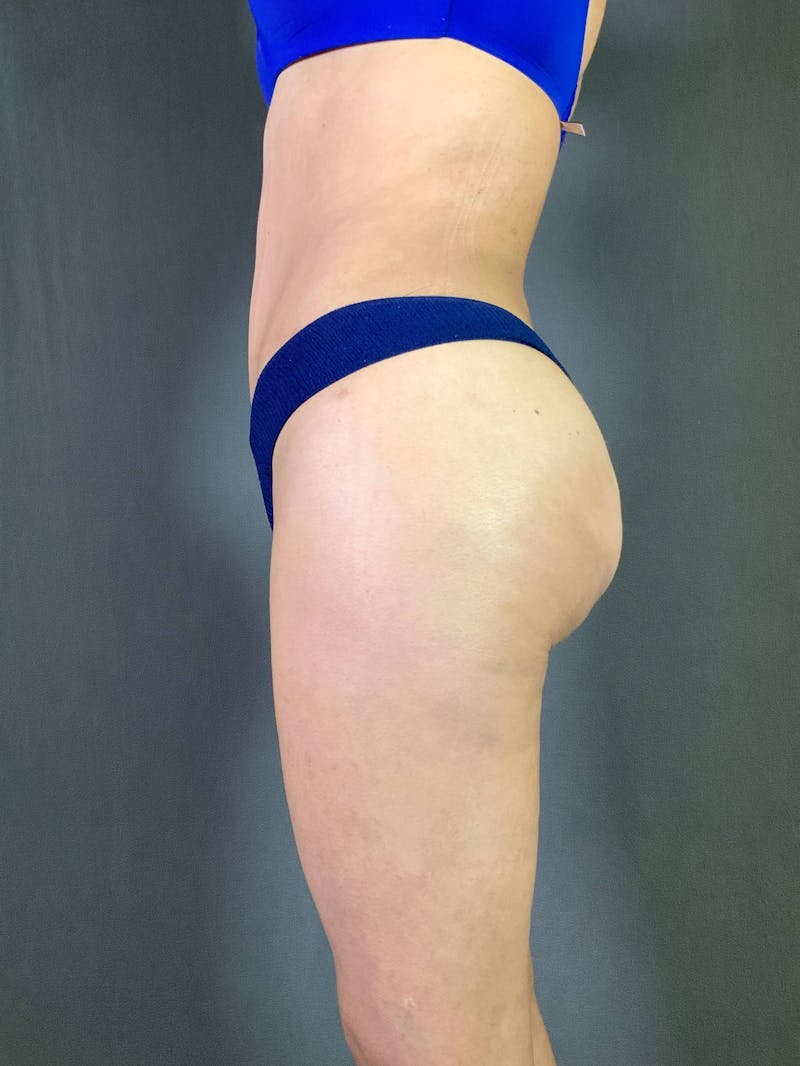 Brazilian Butt Lift Before & After Gallery - Patient 167408781 - Image 3