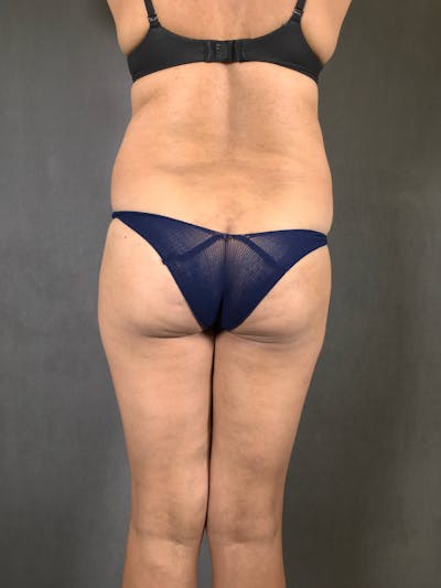 Brazilian Butt Lift Before & After Gallery - Patient 167408781 - Image 1