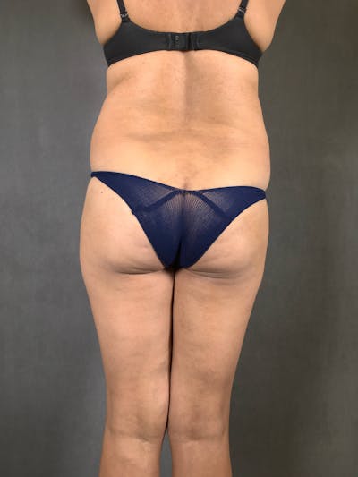 Brazilian Butt Lift Before & After Gallery - Patient 167408781 - Image 1