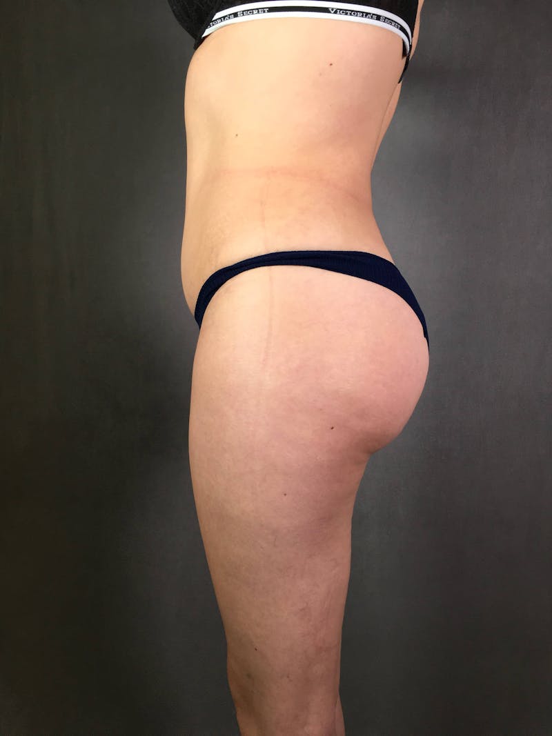 Brazilian Butt Lift Before & After Gallery - Patient 167408782 - Image 4