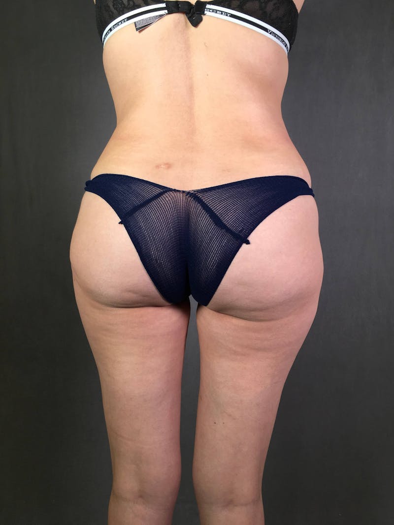 Brazilian Butt Lift Before & After Gallery - Patient 167408782 - Image 1