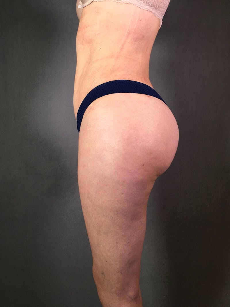 Brazilian Butt Lift Before & After Gallery - Patient 167408782 - Image 3
