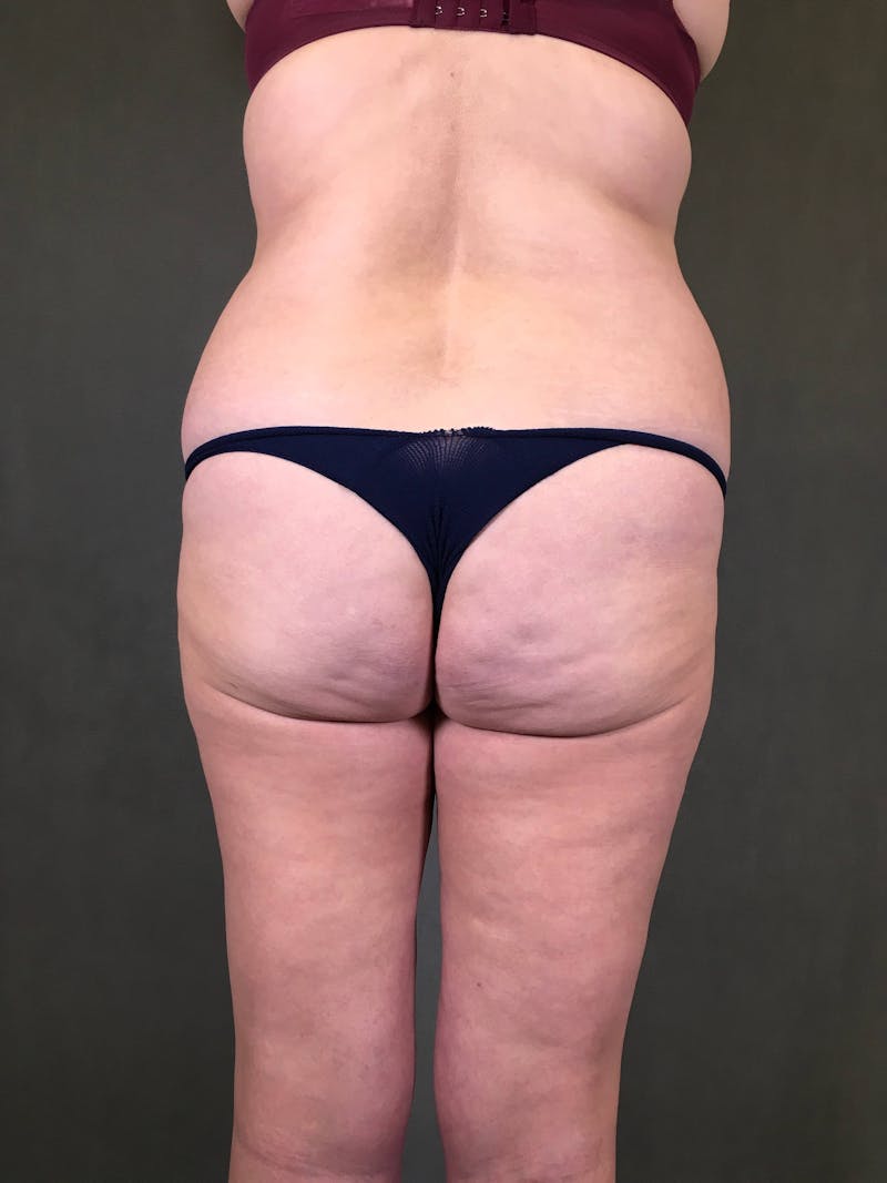 Brazilian Butt Lift Before & After Gallery - Patient 167408788 - Image 1