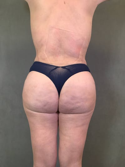 Brazilian Butt Lift Before & After Gallery - Patient 167408788 - Image 2