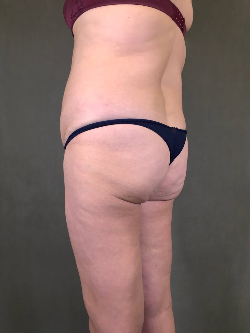 Brazilian Butt Lift Before & After Gallery - Patient 167408788 - Image 3