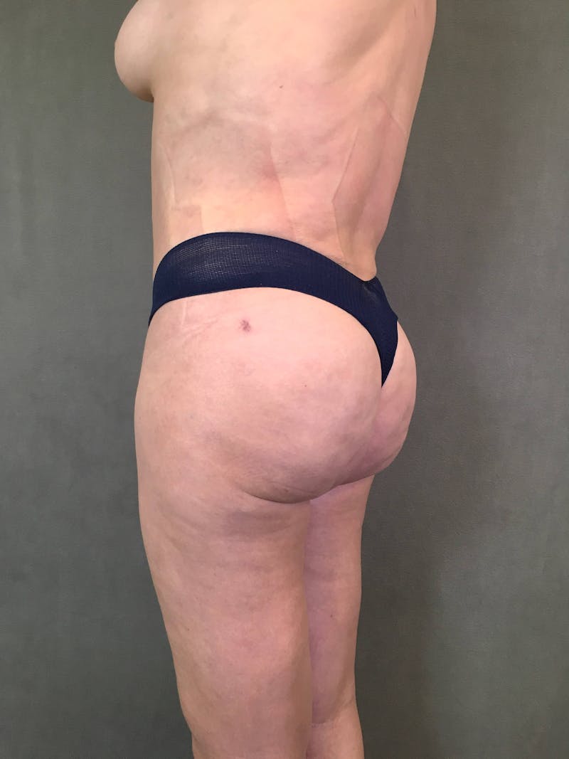 Brazilian Butt Lift Before & After Gallery - Patient 167408788 - Image 4