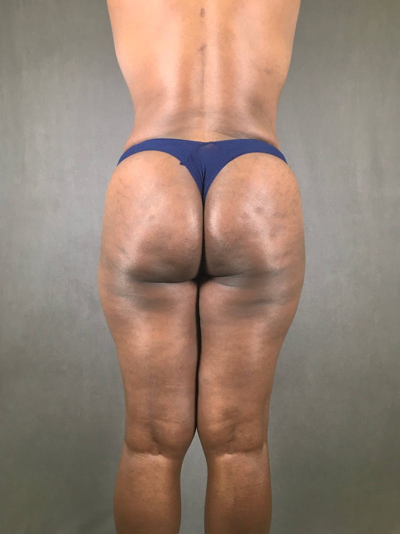 Brazilian Butt Lift Before & After Gallery - Patient 167408790 - Image 2