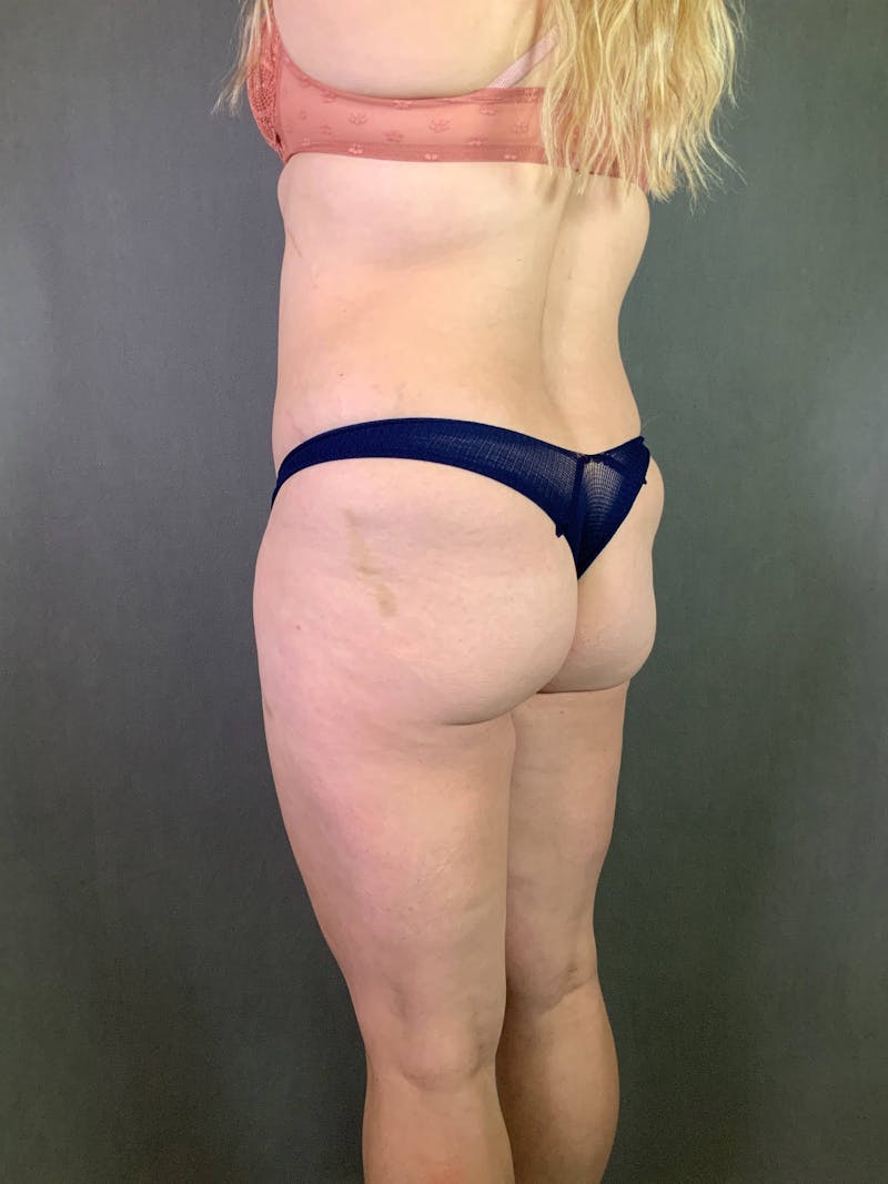 Brazilian Butt Lift Before & After Gallery - Patient 167408791 - Image 3