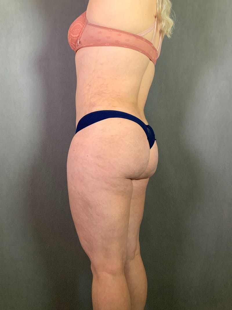 Brazilian Butt Lift Before & After Gallery - Patient 167408791 - Image 4