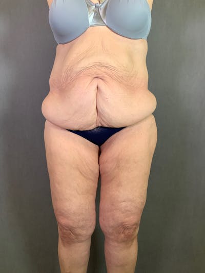 Liposuction Before & After Gallery - Patient 170121685 - Image 1