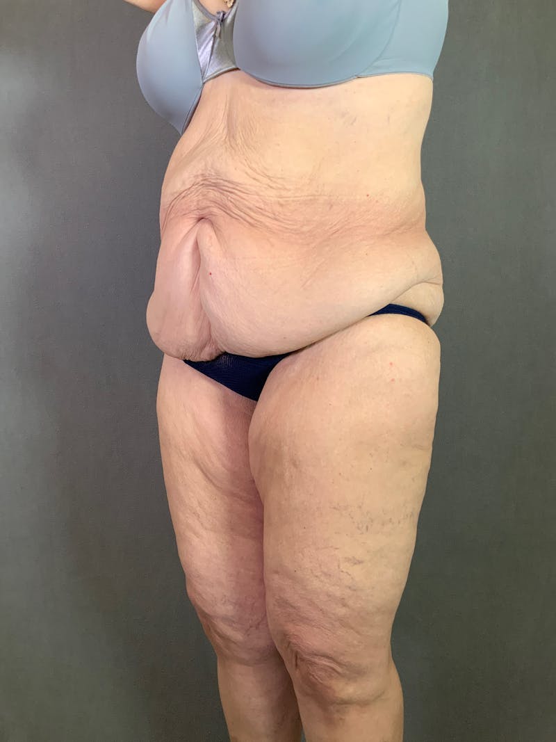 Liposuction Before & After Gallery - Patient 170121685 - Image 3