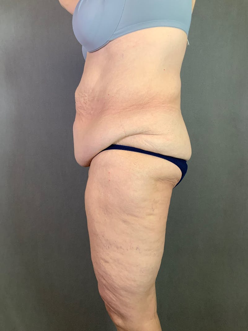 Liposuction Before & After Gallery - Patient 170121685 - Image 5