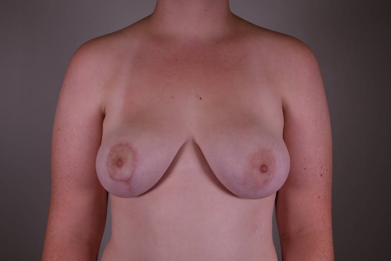 Breast Asymmetry Correction Before & After Gallery - Patient 172096819 - Image 2