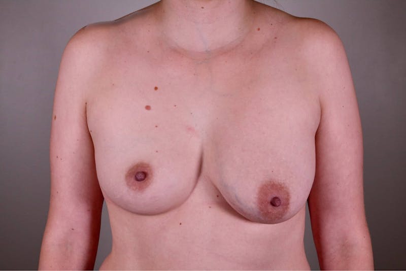 Breast Asymmetry Correction Before & After Gallery - Patient 172096823 - Image 1