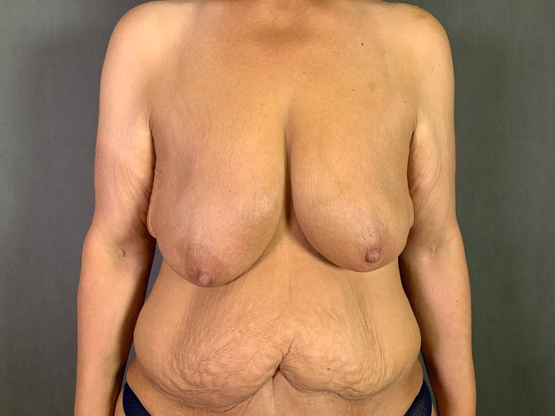 Breast Lift with Auto Augmentation (After Massive Weight Loss) Before & After Gallery - Patient 172096870 - Image 1