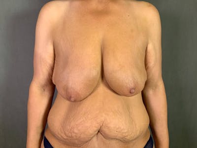 Breast Lift with Auto Augmentation (After Massive Weight Loss) Before & After Gallery - Patient 172096870 - Image 2