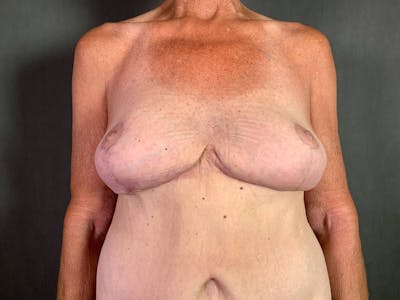 Breast Lift with Auto Augmentation (After Massive Weight Loss) Before & After Gallery - Patient 172096871 - Image 2