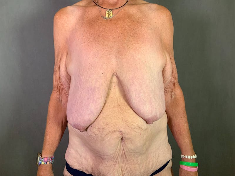 Breast Lift with Auto Augmentation (After Massive Weight Loss) Before & After Gallery - Patient 172096871 - Image 1