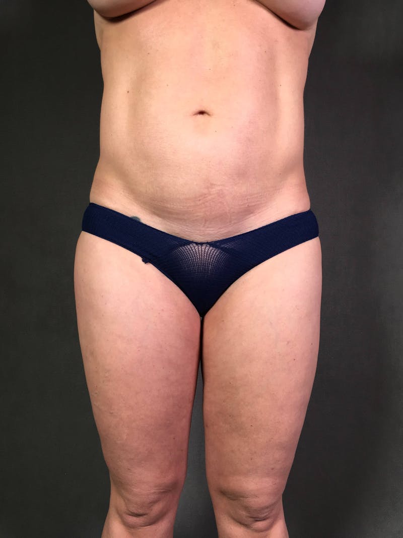 Mini-Tummy Tuck Before & After Gallery - Patient 172098286 - Image 1