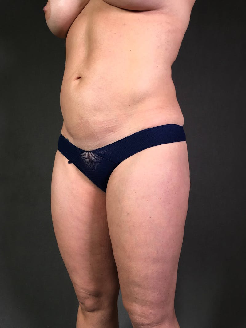 Mini-Tummy Tuck Before & After Gallery - Patient 172098286 - Image 3
