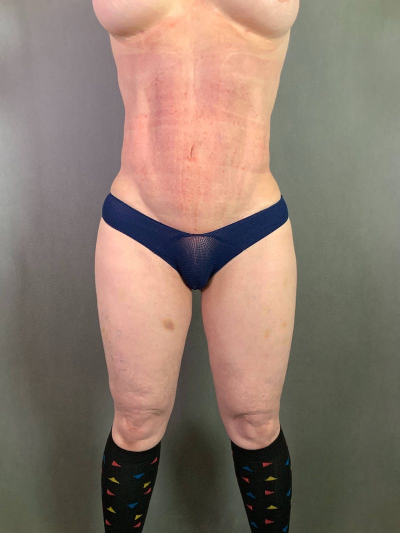 Mini-Tummy Tuck Before & After Gallery - Patient 172098286 - Image 2