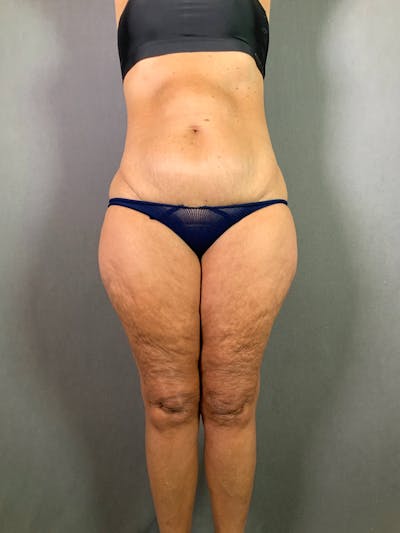 Standard Abdominoplasty Before & After Gallery - Patient 172098299 - Image 1