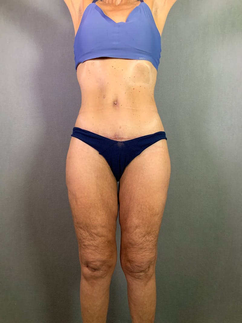 Standard Abdominoplasty Before & After Gallery - Patient 172098299 - Image 2