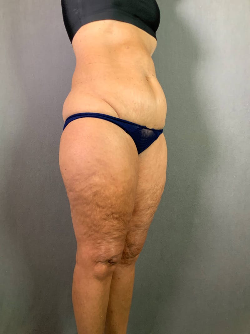Standard Abdominoplasty Before & After Gallery - Patient 172098299 - Image 3