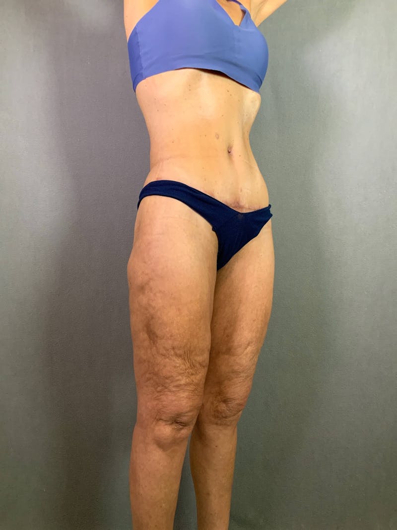 Standard Abdominoplasty Before & After Gallery - Patient 172098299 - Image 4