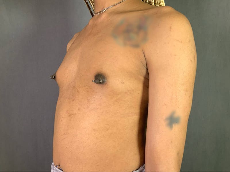 Top Surgery (Male to Female) Before & After Gallery - Patient 172098325 - Image 1