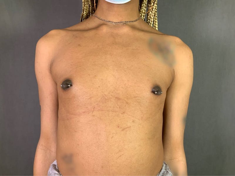 Top Surgery (Male to Female) Before & After Gallery - Patient 172098325 - Image 5