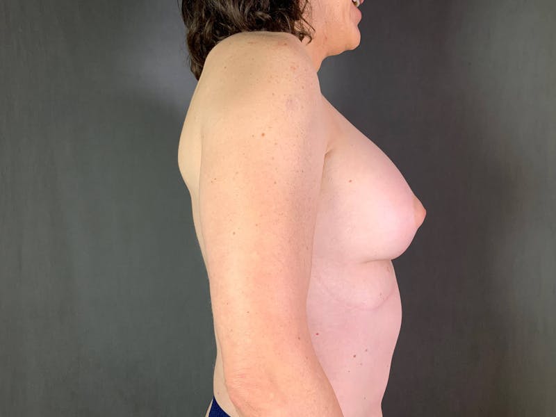 Top Surgery (Male to Female) Before & After Gallery - Patient 172098326 - Image 6
