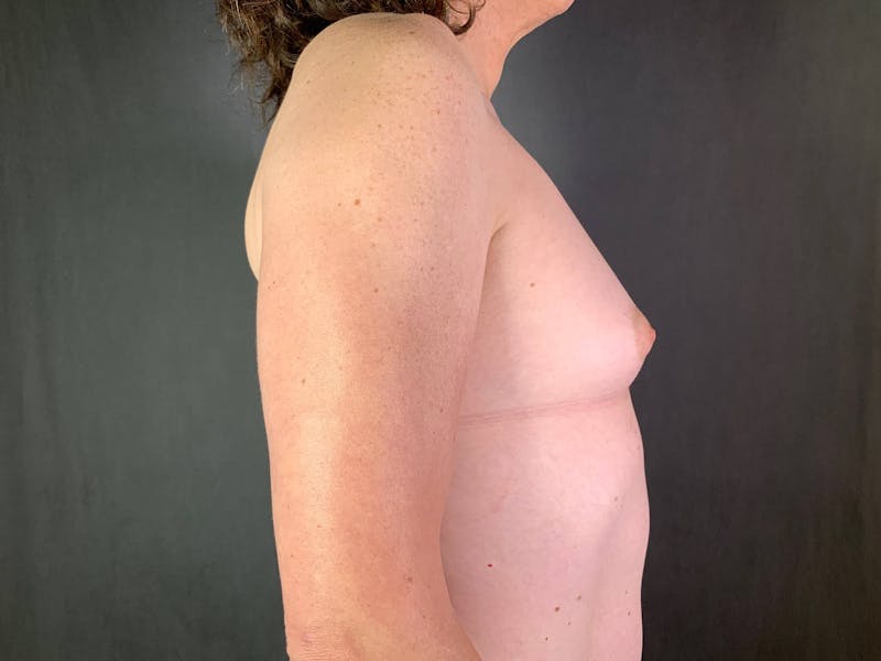 Top Surgery (Male to Female) Before & After Gallery - Patient 172098326 - Image 5