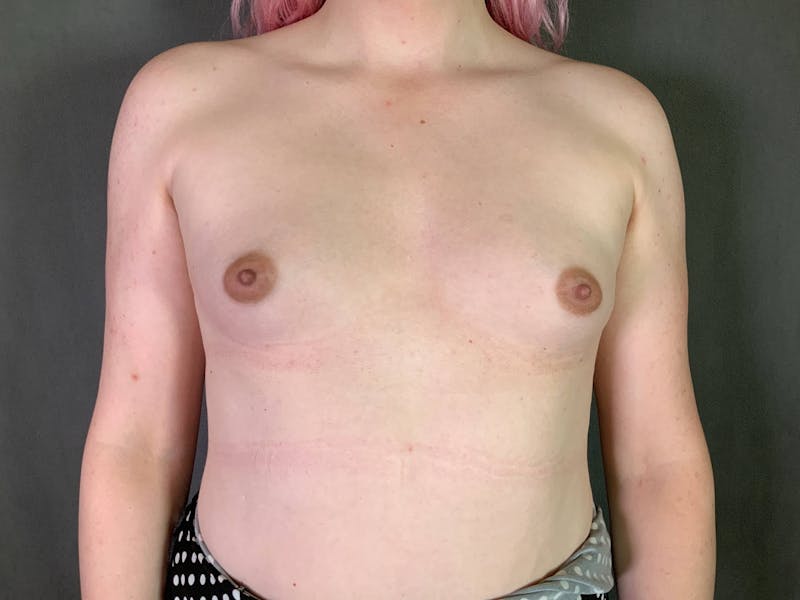Top Surgery (Male to Female) Before & After Gallery - Patient 172098327 - Image 1