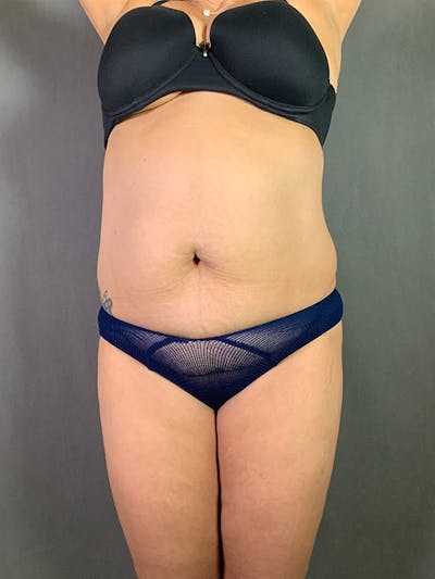 Standard Abdominoplasty Before & After Gallery - Patient 193668010 - Image 1