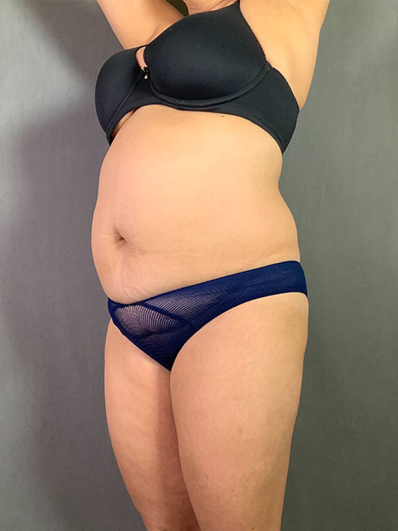 Standard Abdominoplasty Before & After Gallery - Patient 193668010 - Image 3