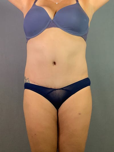 Standard Abdominoplasty Before & After Gallery - Patient 193668010 - Image 2