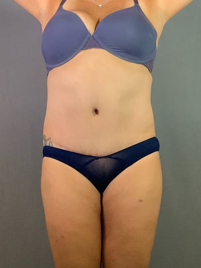 Standard Abdominoplasty Before & After Gallery - Patient 193668010 - Image 2