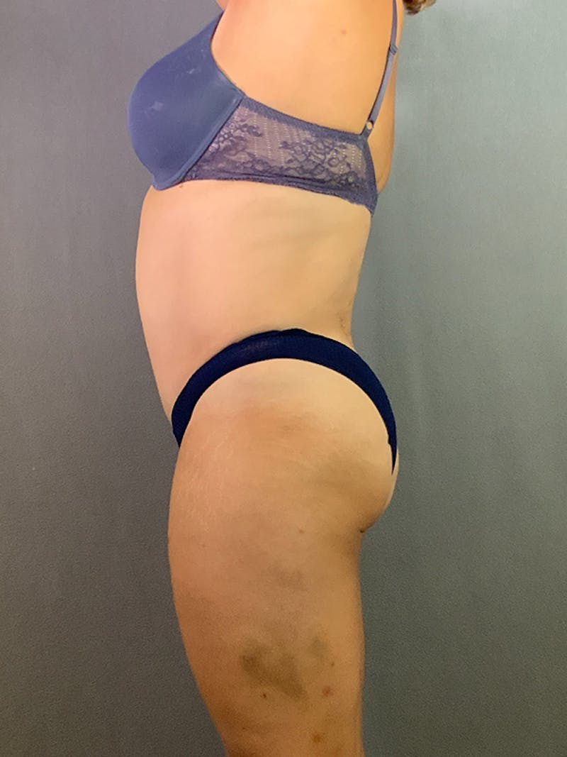 Standard Abdominoplasty Before & After Gallery - Patient 193668010 - Image 6