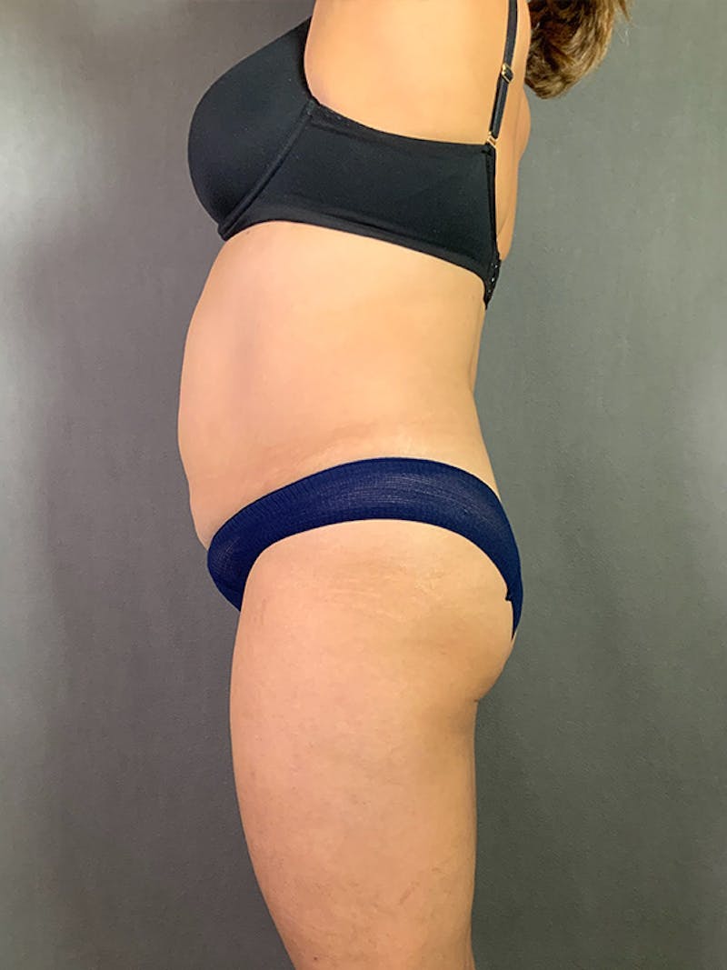 Standard Abdominoplasty Before & After Gallery - Patient 193668010 - Image 5