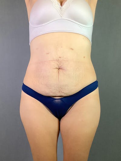 Standard Abdominoplasty Before & After Gallery - Patient 193668020 - Image 1