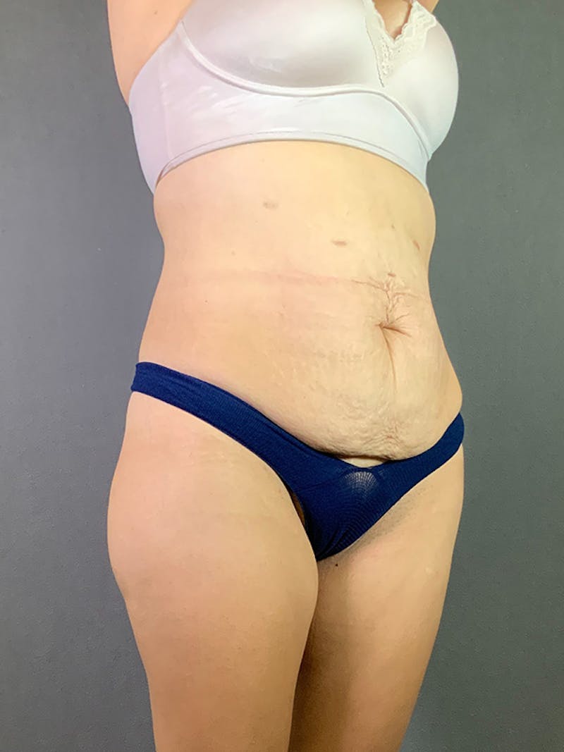 Standard Abdominoplasty Before & After Gallery - Patient 193668020 - Image 3